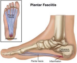 Plantar Fasciitis & Heel Pain