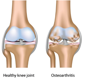 osteoarthritis-knee