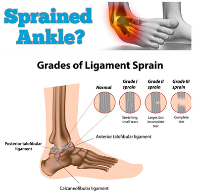 Ankle Sprain Tissue Damage